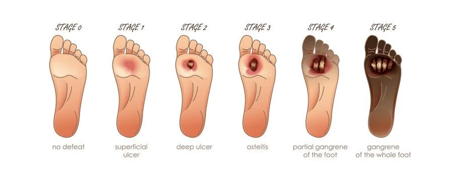Home and Outreach Services at 14Steps Diabetic Foot Center